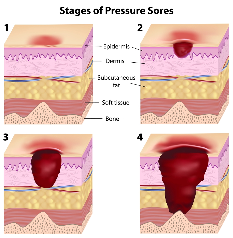 Pressure Ulcer
