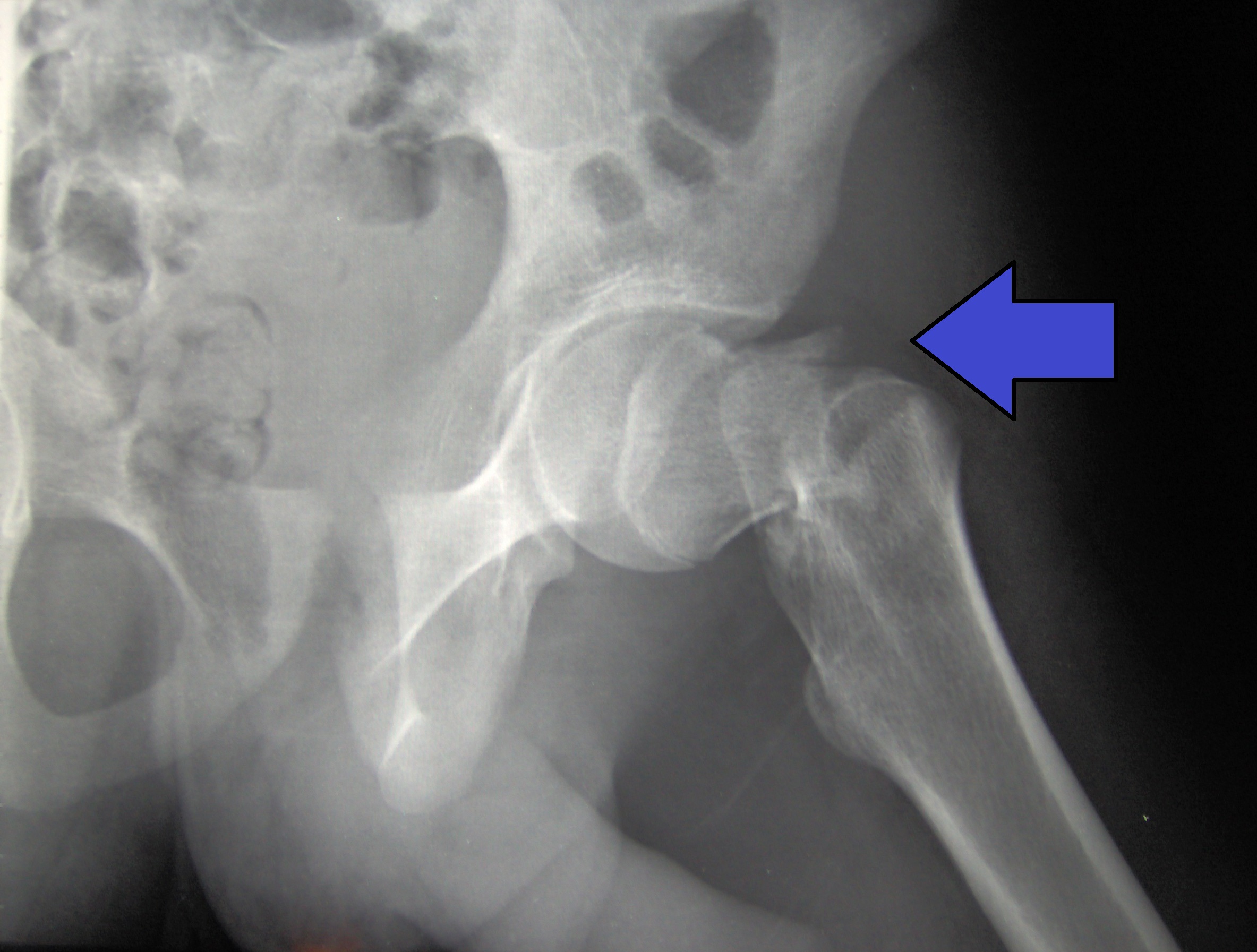 Cdm Hip Fracture 343