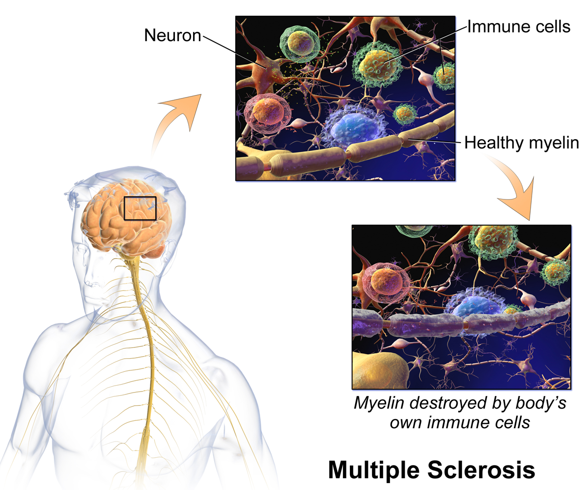 Multiple Sclerosis